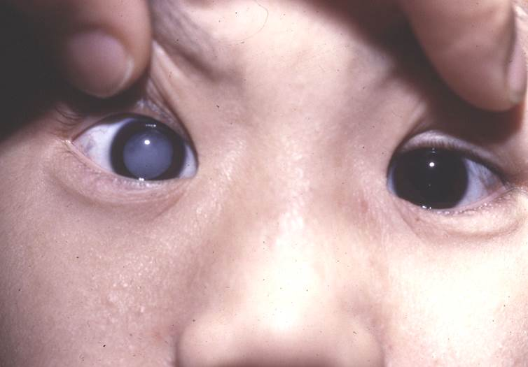 小兒眼病,?，斎鹨曆劭?上海眼科醫(yī)院