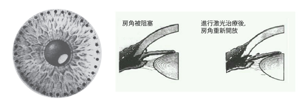 青光眼,?，斎鹨曆劭?上海眼科醫(yī)院