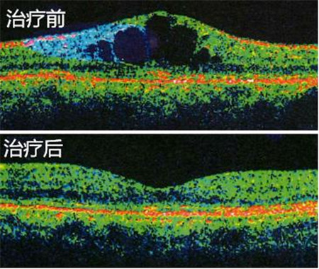 玻璃體視網(wǎng)膜,?，斎鹨曆劭?上海眼科醫(yī)院