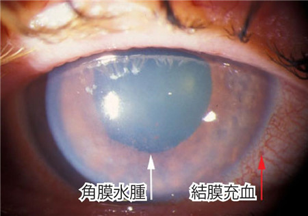 青光眼,?，斎鹨曆劭?上海眼科醫(yī)院