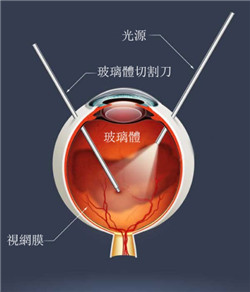 玻璃體視網(wǎng)膜,?，斎鹨曆劭?上海眼科醫(yī)院