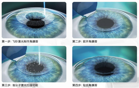 屈光矯視,希瑪瑞視眼科,上海眼科醫(yī)院