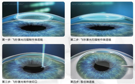 屈光矯視,?，斎鹨曆劭?上海眼科醫(yī)院