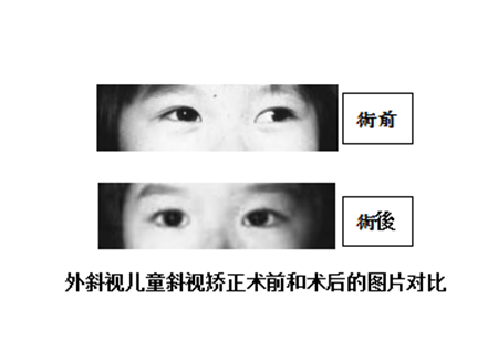 小兒眼病,?，斎鹨曆劭?上海眼科醫(yī)院