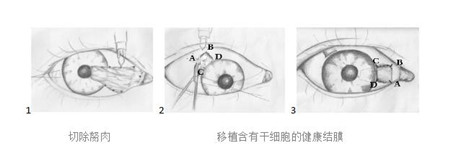眼表眼角膜,希瑪瑞視眼科,上海眼科醫(yī)院
