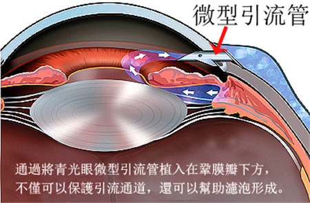 青光眼,希瑪瑞視眼科,上海眼科醫(yī)院