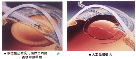 白內(nèi)障,?，斎鹨曆劭?上海眼科醫(yī)院