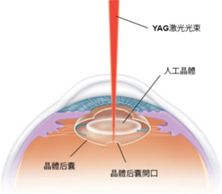 白內(nèi)障,希瑪瑞視眼科,上海眼科醫(yī)院