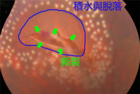 玻璃體視網(wǎng)膜,?，斎鹨曆劭?上海眼科醫(yī)院