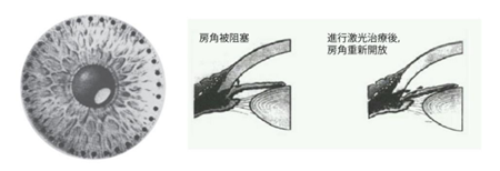 青光眼,?，斎鹨曆劭?上海眼科醫(yī)院