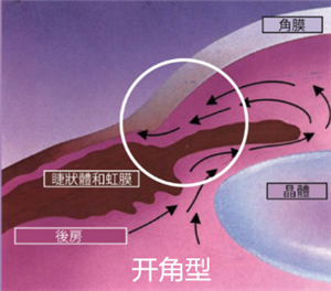 青光眼,希瑪瑞視眼科,上海眼科醫(yī)院