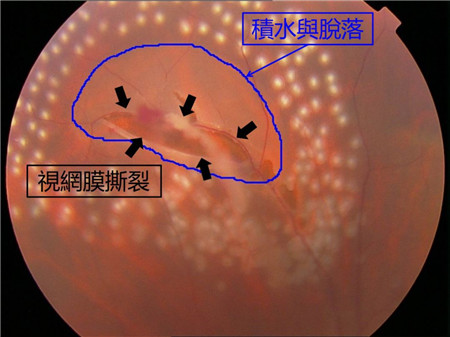 玻璃體視網(wǎng)膜,?，斎鹨曆劭?上海眼科醫(yī)院