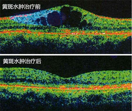 玻璃體視網(wǎng)膜,?，斎鹨曆劭?上海眼科醫(yī)院