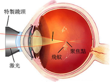 玻璃體視網(wǎng)膜,希瑪瑞視眼科,上海眼科醫(yī)院