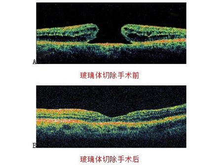 玻璃體視網(wǎng)膜,?，斎鹨曆劭?上海眼科醫(yī)院