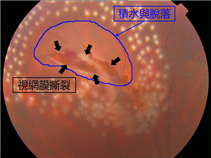 玻璃體視網(wǎng)膜,?，斎鹨曆劭?上海眼科醫(yī)院