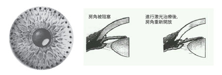 青光眼,?，斎鹨曆劭?上海眼科醫(yī)院