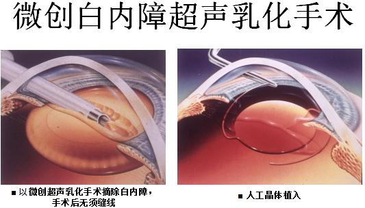 白內(nèi)障,希瑪瑞視眼科,上海眼科醫(yī)院