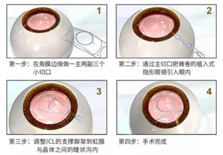屈光矯視,希瑪瑞視眼科,上海眼科醫(yī)院
