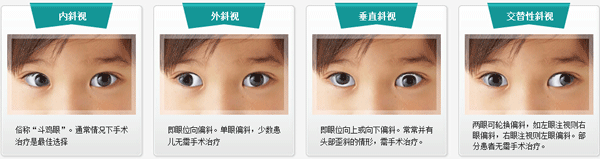小兒眼病,希瑪瑞視眼科,上海眼科醫(yī)院