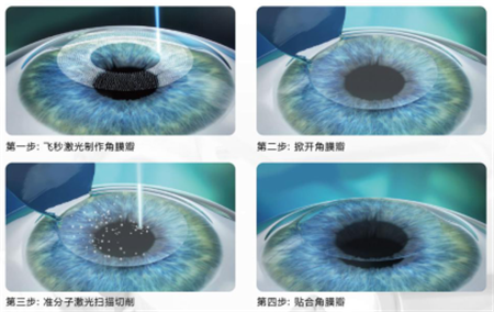 屈光矯視,希瑪瑞視眼科,上海眼科醫(yī)院