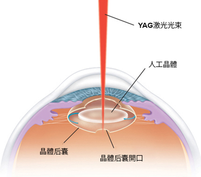 白內(nèi)障,?，斎鹨曆劭?上海眼科醫(yī)院
