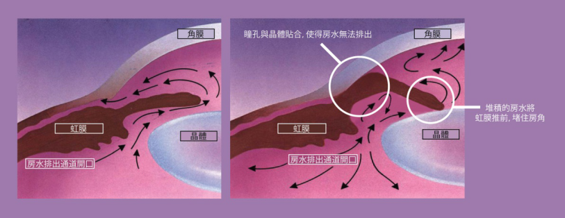 青光眼,希瑪瑞視眼科,上海眼科醫(yī)院