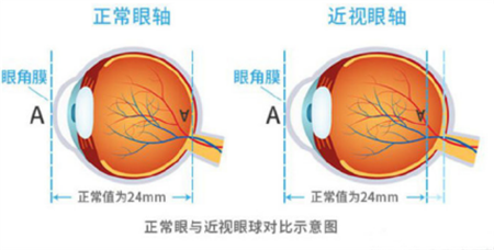 屈光矯視,?，斎鹨曆劭?上海眼科醫(yī)院