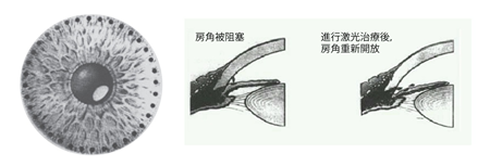 青光眼,?，斎鹨曆劭?上海眼科醫(yī)院