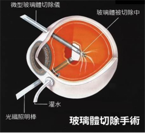 玻璃體視網(wǎng)膜,希瑪瑞視眼科,上海眼科醫(yī)院