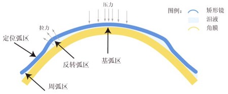 屈光矯視,希瑪瑞視眼科,上海眼科醫(yī)院