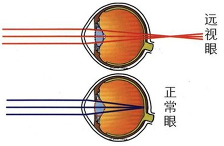 屈光矯視,?，斎鹨曆劭?上海眼科醫(yī)院
