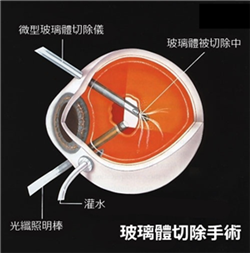 玻璃體視網(wǎng)膜,?，斎鹨曆劭?上海眼科醫(yī)院