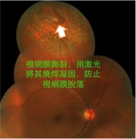 玻璃體視網(wǎng)膜,?，斎鹨曆劭?上海眼科醫(yī)院