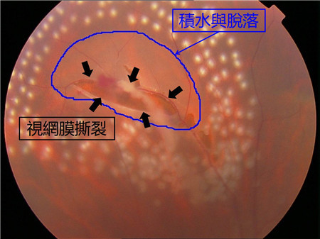 玻璃體視網(wǎng)膜,希瑪瑞視眼科,上海眼科醫(yī)院