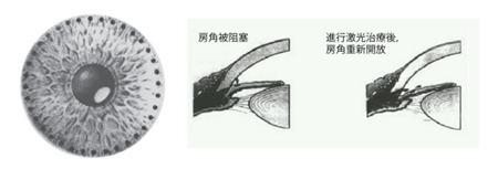 青光眼,?，斎鹨曆劭?上海眼科醫(yī)院