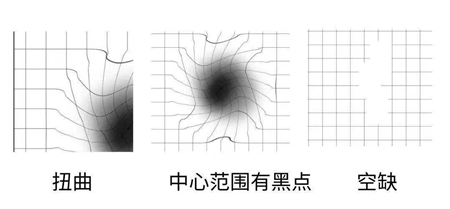 玻璃體視網(wǎng)膜,?，斎鹨曆劭?上海眼科醫(yī)院