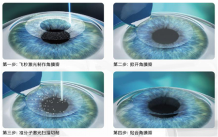 屈光矯視,希瑪瑞視眼科,上海眼科醫(yī)院
