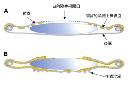 白內(nèi)障,?，斎鹨曆劭?上海眼科醫(yī)院