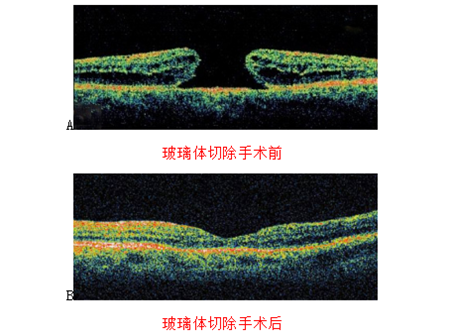 玻璃體視網(wǎng)膜,希瑪瑞視眼科,上海眼科醫(yī)院