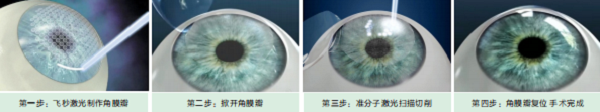屈光矯視,希瑪瑞視眼科,上海眼科醫(yī)院