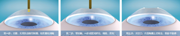 屈光矯視,希瑪瑞視眼科,上海眼科醫(yī)院