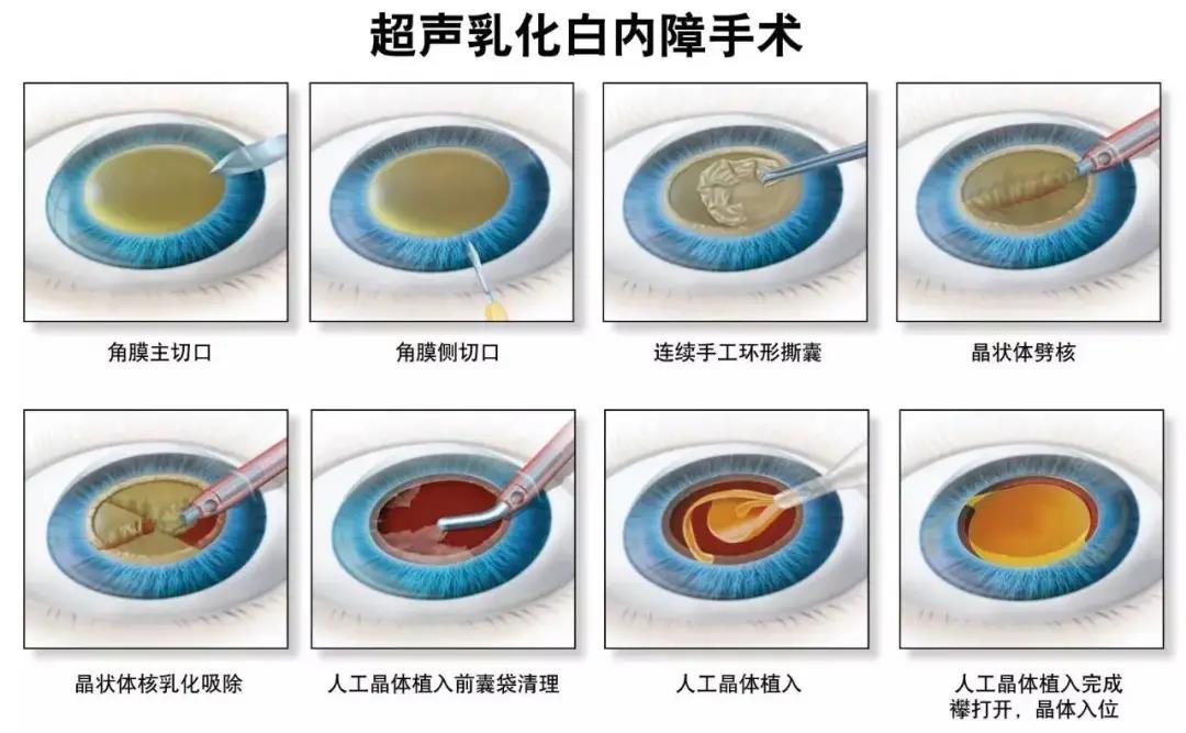 白內(nèi)障,?，斎鹨曆劭?上海眼科醫(yī)院