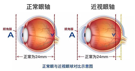 屈光矯視,?，斎鹨曆劭?上海眼科醫(yī)院