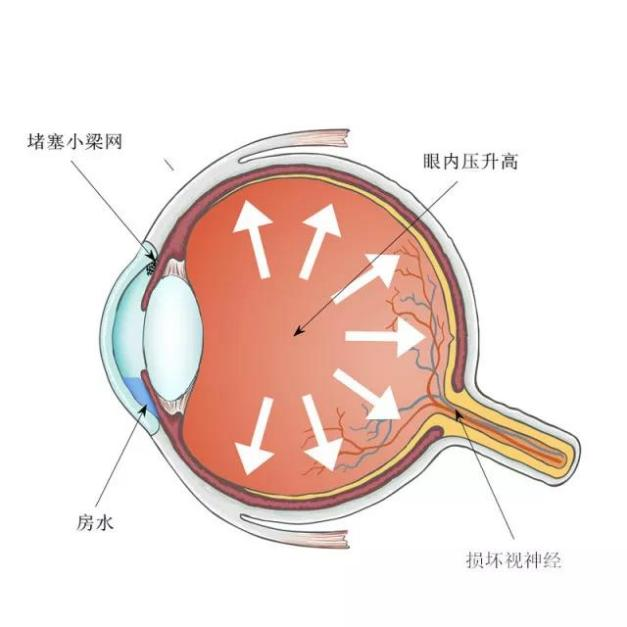 青光眼,?，斎鹨曆劭?上海眼科醫(yī)院