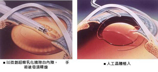 小兒眼病,?，斎鹨曆劭?上海眼科醫(yī)院