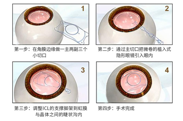 屈光矯視,?，斎鹨曆劭?上海眼科醫(yī)院