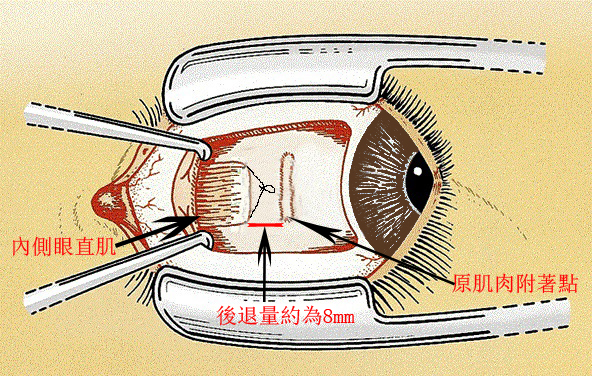 小兒眼病,希瑪瑞視眼科,上海眼科醫(yī)院