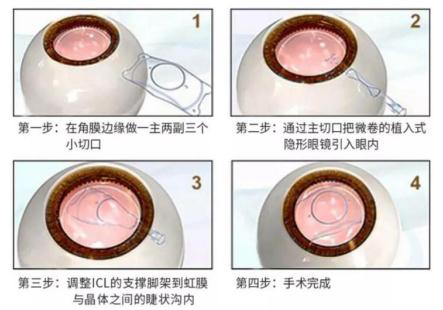 屈光矯視,希瑪瑞視眼科,上海眼科醫(yī)院