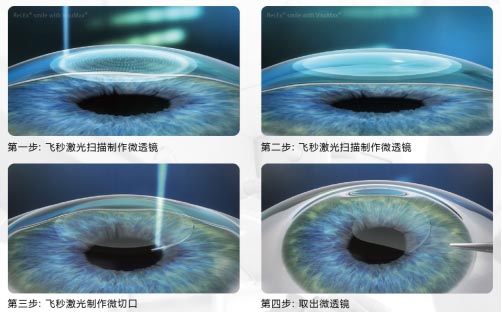 屈光矯視,?，斎鹨曆劭?上海眼科醫(yī)院